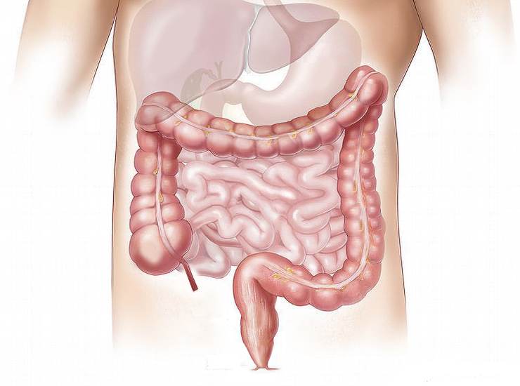 Sintomi tumore al colon