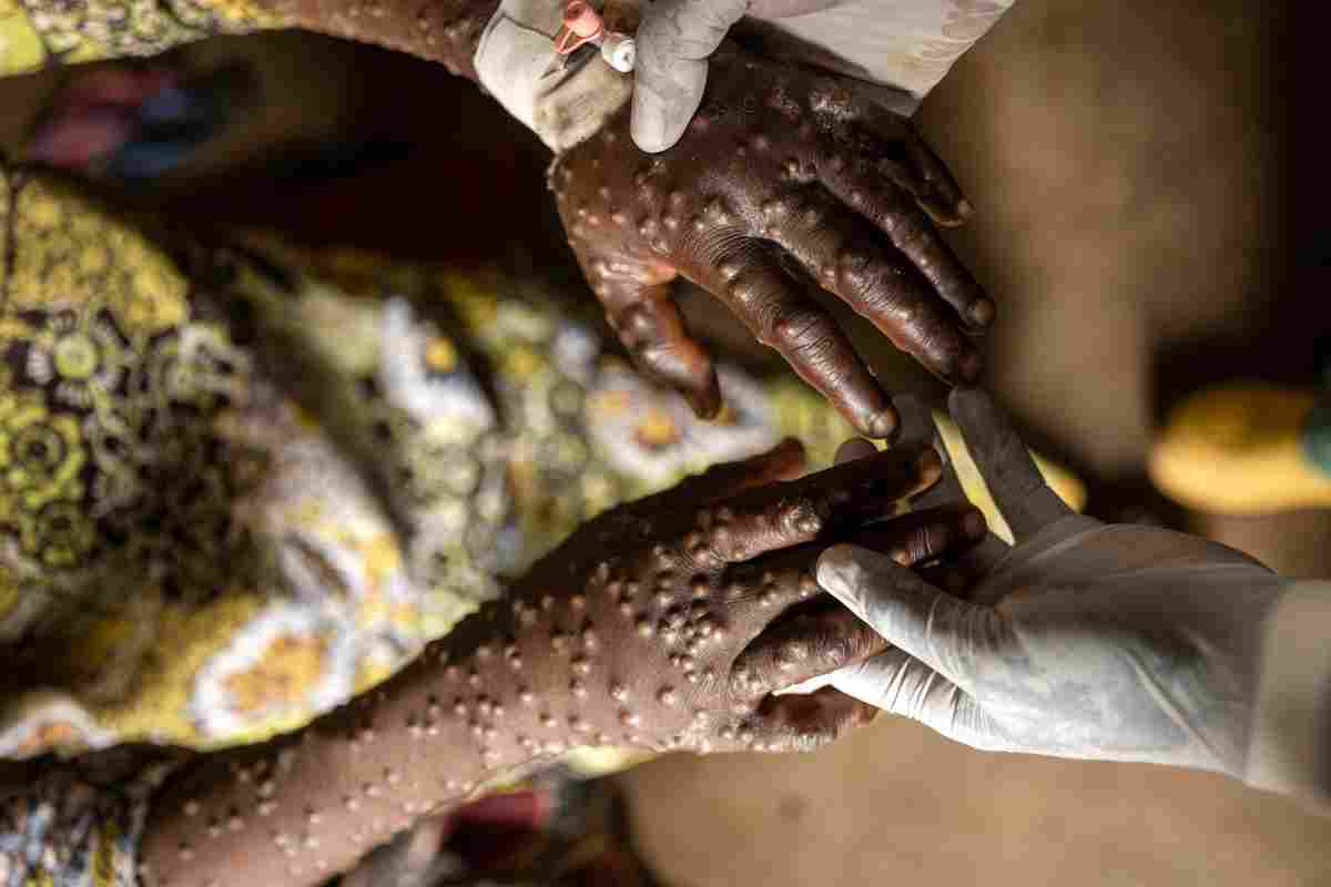 Vaiolo delle scimmie (Mpox), pronto il primo vaccino: ecco il nome, chi lo produce e come va somministrato