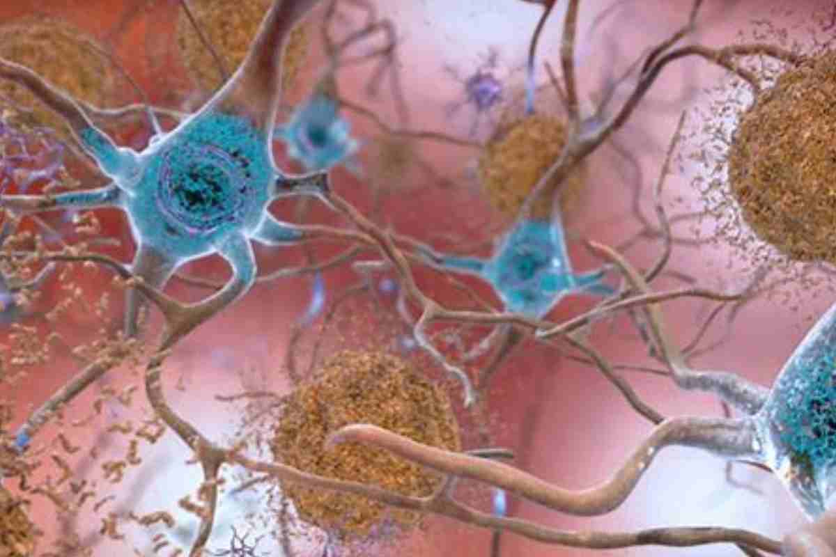 Alzheimer: una scoperta e forse la chiave per fermare la malattia